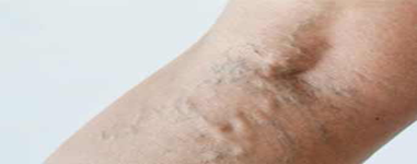 Non-operative Treatment of Varicose Vein 