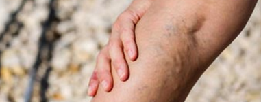 I Have Varicose Vein(s), What Should I Do?