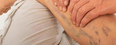 What Is Varicose Vein