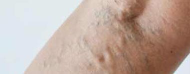 Varicose Veins Types